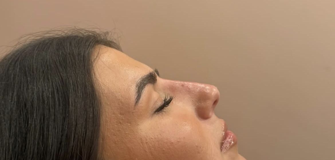 Profile after treatment